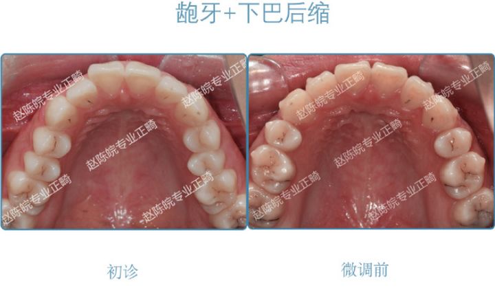 杭州成人隐形矫正牙齿优惠,矫正牙齿杭州无创伤