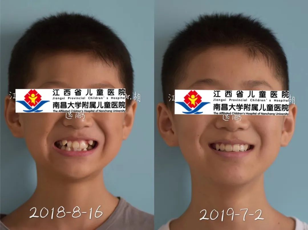 有没有办法把长歪的牙齿矫正,成年牙齿歪了怎么矫正大概要多久