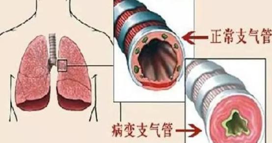 96岁老人久病成“良医”，分享2个秘籍，老慢支几十年不发作
