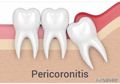 孕期牙疼最佳解决办法,孕期牙疼最好的缓解办法