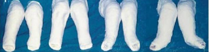 足内翻矫正鞋真的可以矫正吗,马蹄内翻足矫正鞋要穿多久