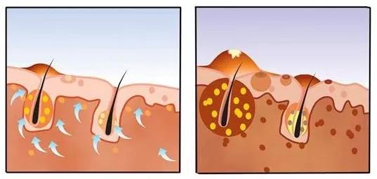 头皮和脸上长痘痘,头皮长痘痘怎么办用什么洗发水