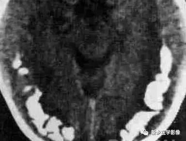 颅内有钙化怎么治疗,34岁脑部有钙化正常吗