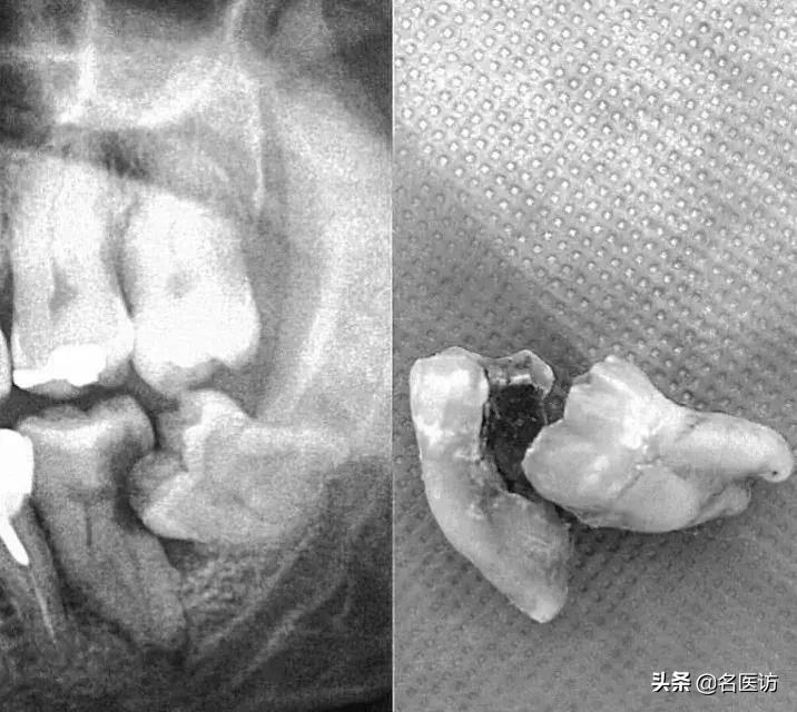 智齿顶坏前牙牙根怎么办,智齿顶坏大牙治疗视频