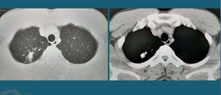 ct怎么判断肺结核有没有传染性,刚刚感染肺结核能从ct上看出来吗