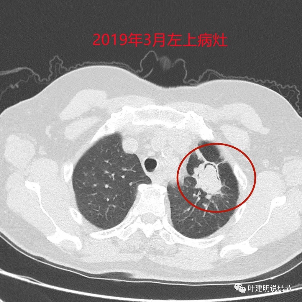 左肺癌手术半年右肺下角还有炎症,左下肺癌晚期