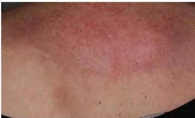 皮肌炎或多发性肌炎的诊断标准,成人皮肌炎与儿童皮肌炎区别