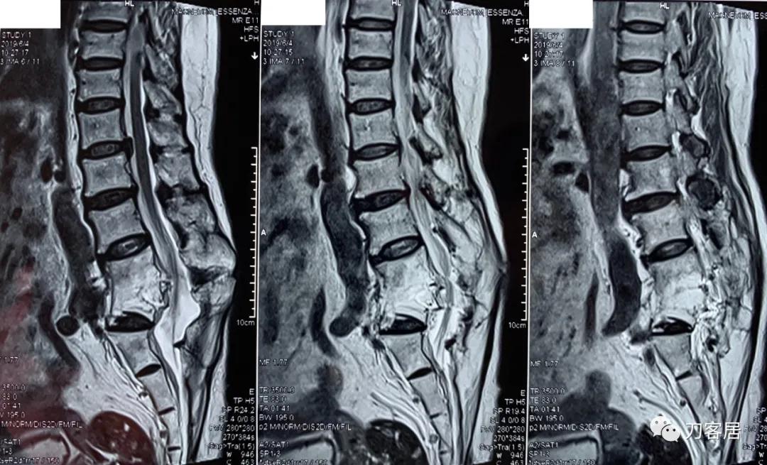腰椎结核手术没有清病灶,腰椎结核术后不排气