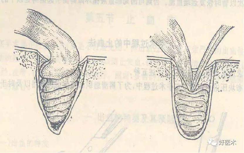 外科手术血管结扎法,外科血管止血结扎的基本操作