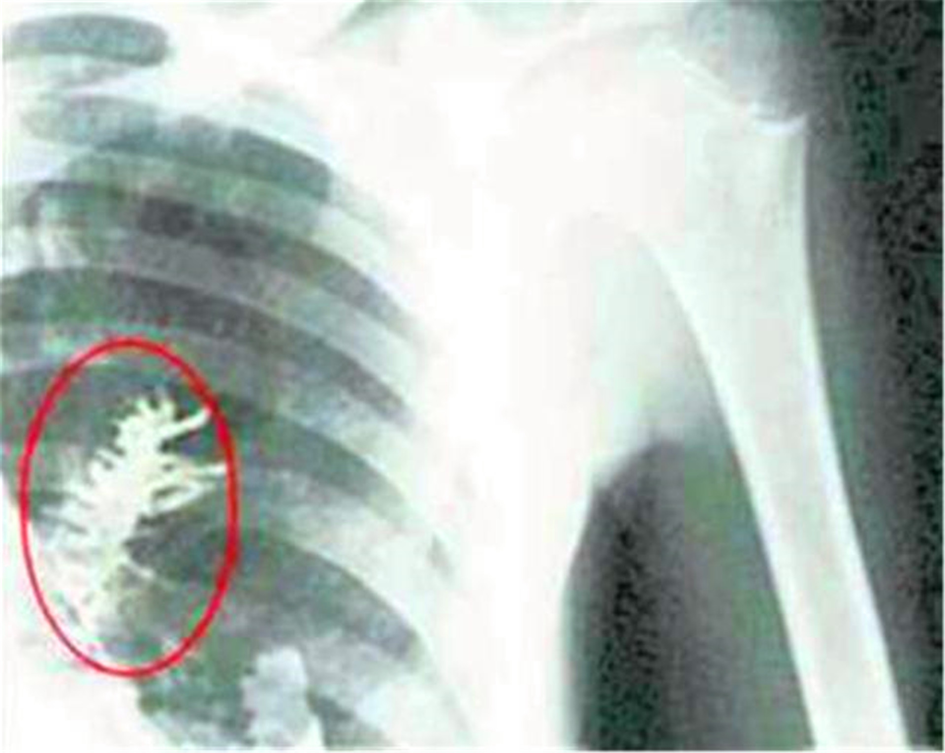 男子确诊肺癌早期被医生劝回,男子肺癌手术发现长了一棵冷杉树