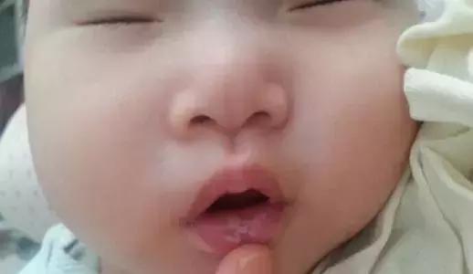 一个月的宝宝鹅口疮怎么治,宝宝鹅口疮怎么反反复复