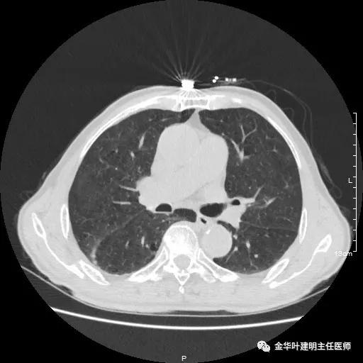 多发原发肺癌能根治吗,肺部原发性恶性肿瘤好治