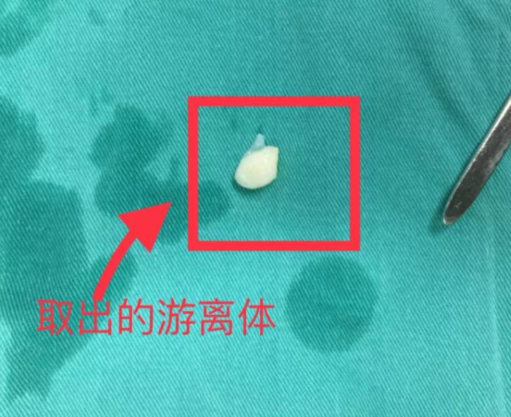 微创手术能治好骨性关节炎吗,膝盖关节镜微创手术要脱衣服吗