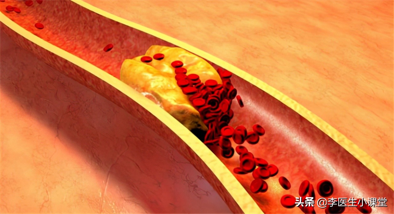 预防脑梗怎么补充叶酸和维生素b12,老年人补充叶酸预防脑梗有讲究