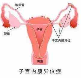 痛经、同房痛、不孕……可能指向同一种妇科病