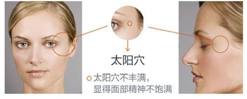 中山哪里假体填充太阳穴,假体填充太阳穴哪里可以做