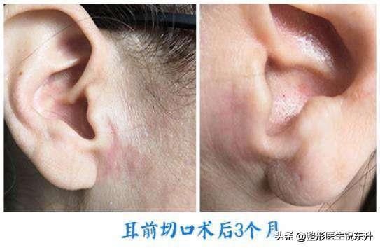 面部五层提升可以维持多久,做完面部提升三件套