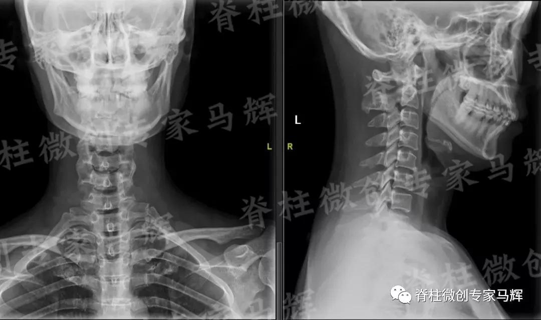 脊椎压迫神经做了微创术后腿麻疼,神经根损伤疼痛治疗