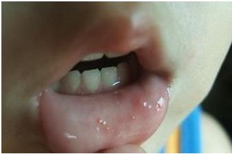 幼儿手足口病怎样叫家长开证明,孩子得了手足口病用什么药