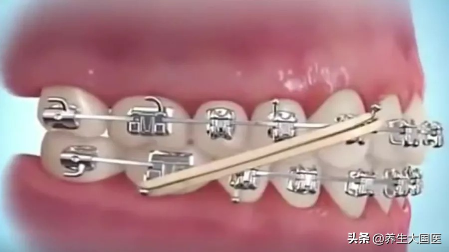 各种牙齿矫正的优缺点,牙齿矫正后对面部有改善吗
