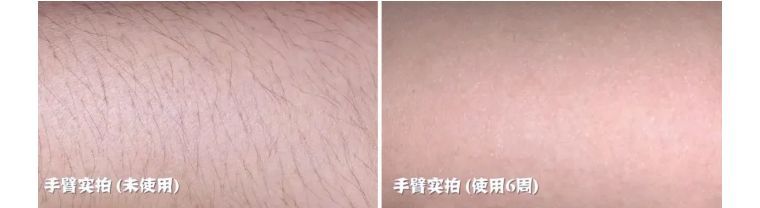 j-style冰点脱毛仪,j-style光子嫩肤脱毛仪