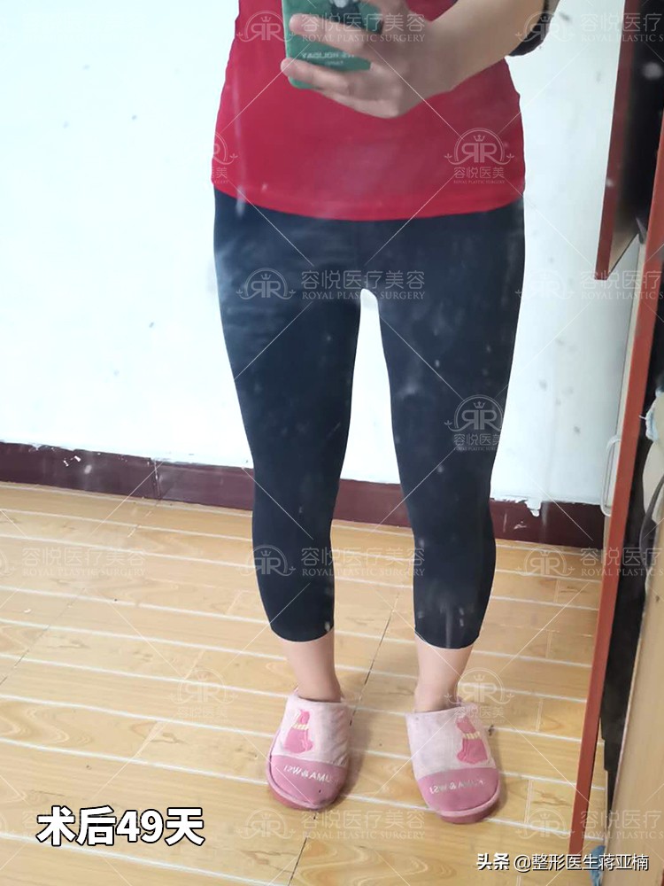 腿细腿部吸脂,大腿吸脂立马变细吗