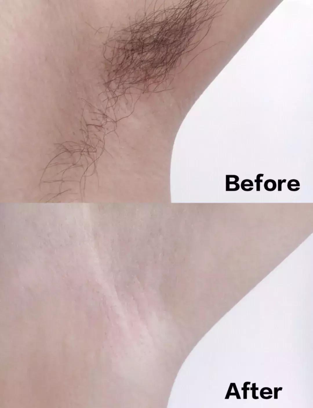 夏天最靠谱的脱毛攻略,脱毛现在最好的技术是