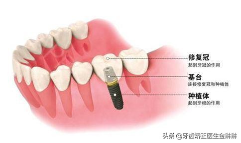 种植牙不用切牙龈做法,种牙不用缝线吗