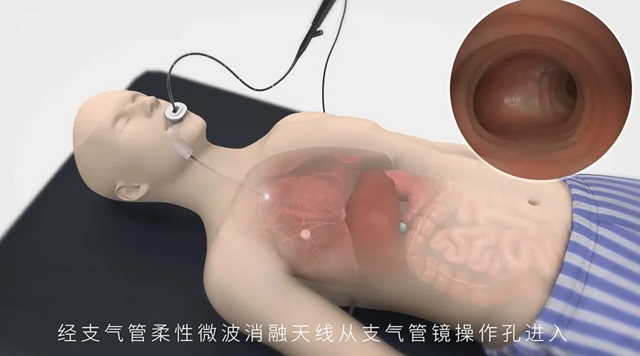 赛诺微射频消融仪,赛诺微射频消融