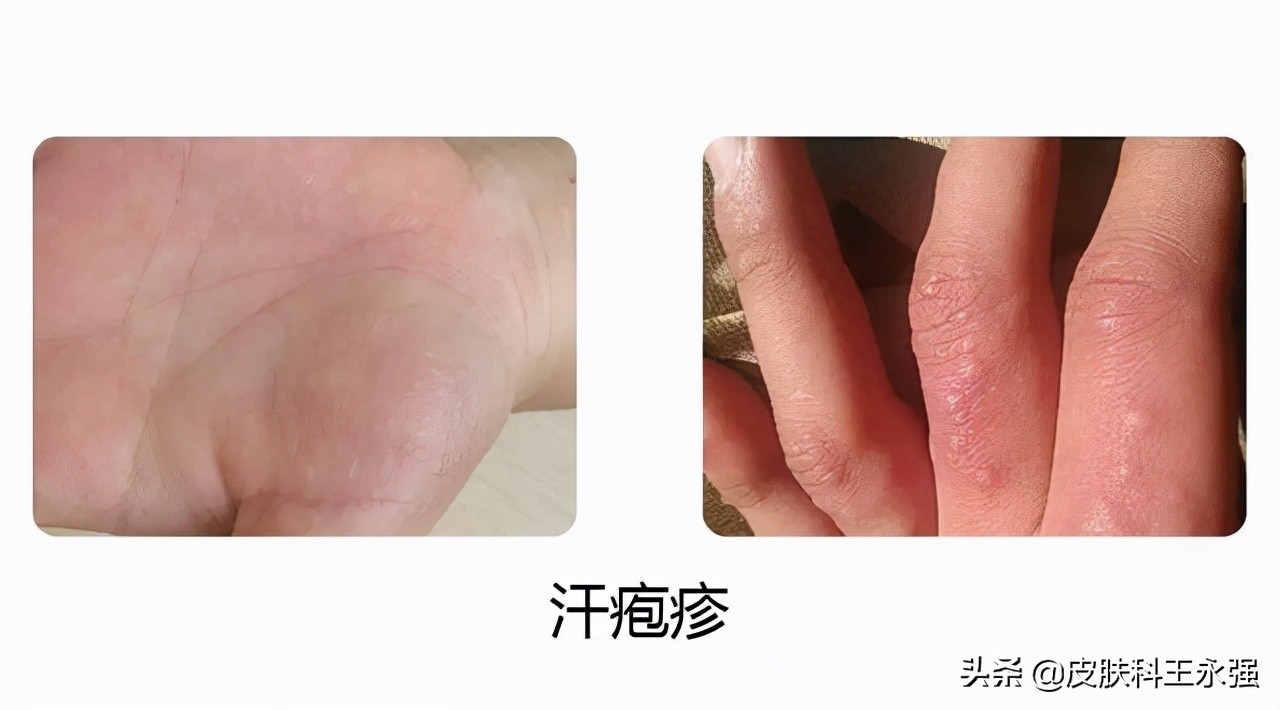 汗疱疹瘙痒严重怎么办,汗疱疹奇痒无比如何缓解