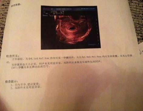 孕早期b超单子怎么看数据,孕早期b超单上怎么看数据