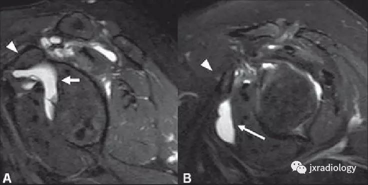 肩关节周围滑囊有哪些,肩关节滑囊疝严重吗
