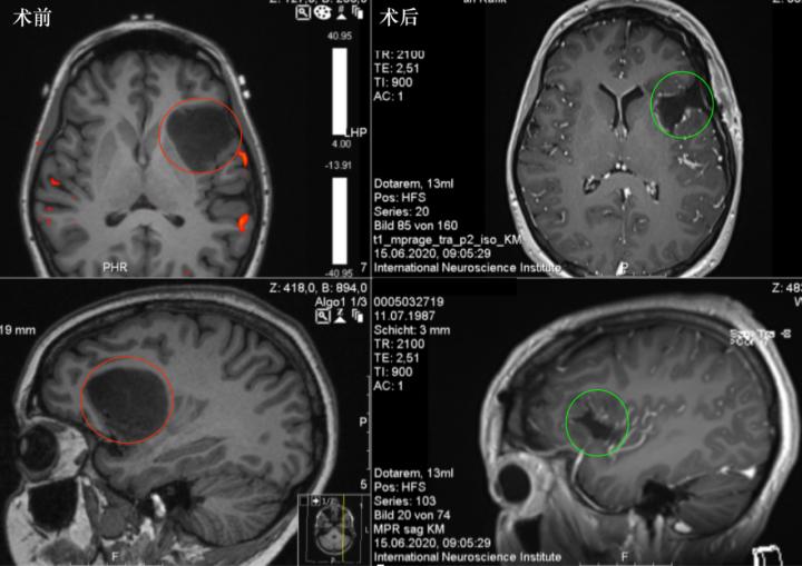 岛叶胶质瘤手术是开颅还是微创,岛叶良性胶质瘤复发率
