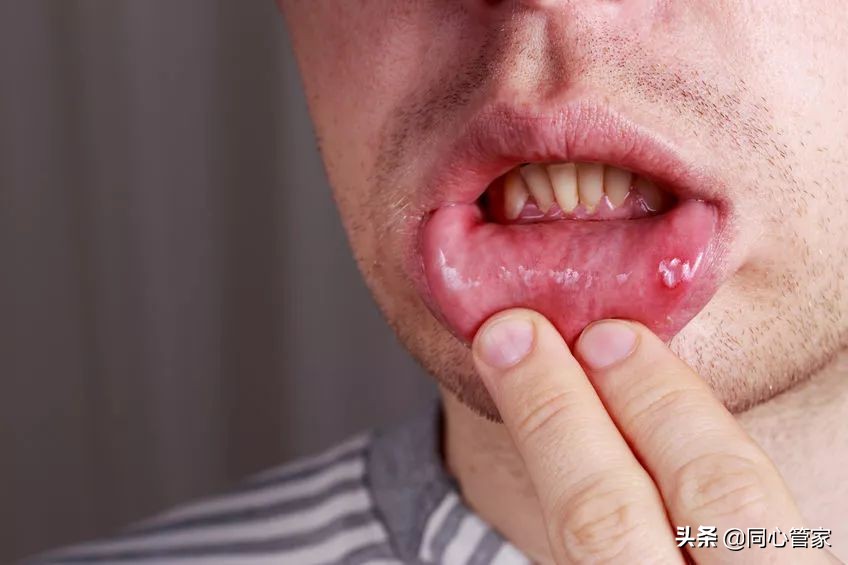 吃冠心病的药会口腔溃疡吗,吃冠心病的药引起胃痛怎么办