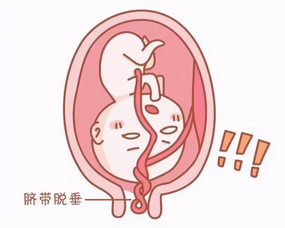 脐带脱垂产妇抢救视频,医生跪着抢救脐带脱垂胎儿