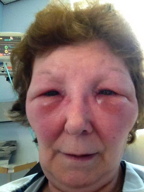 英国女子被假医生注射肉毒杆菌,脸部肿胀像外星人,差点丧命