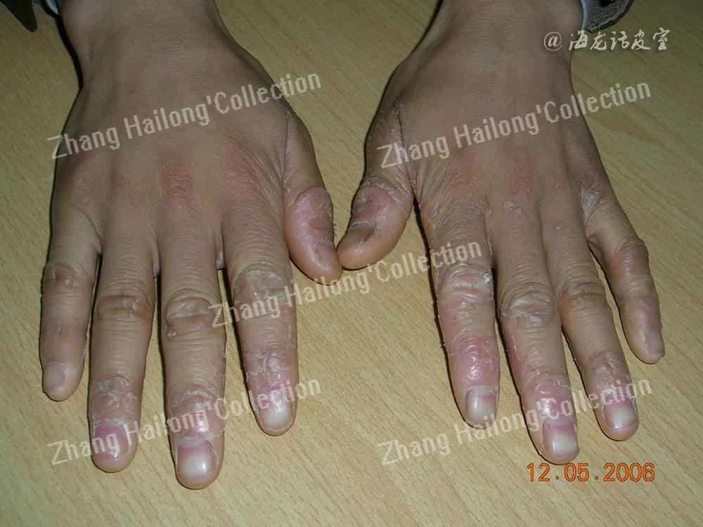 手部湿疹怎样治疗才能断根,手部湿疹怎么治用些什么药呢