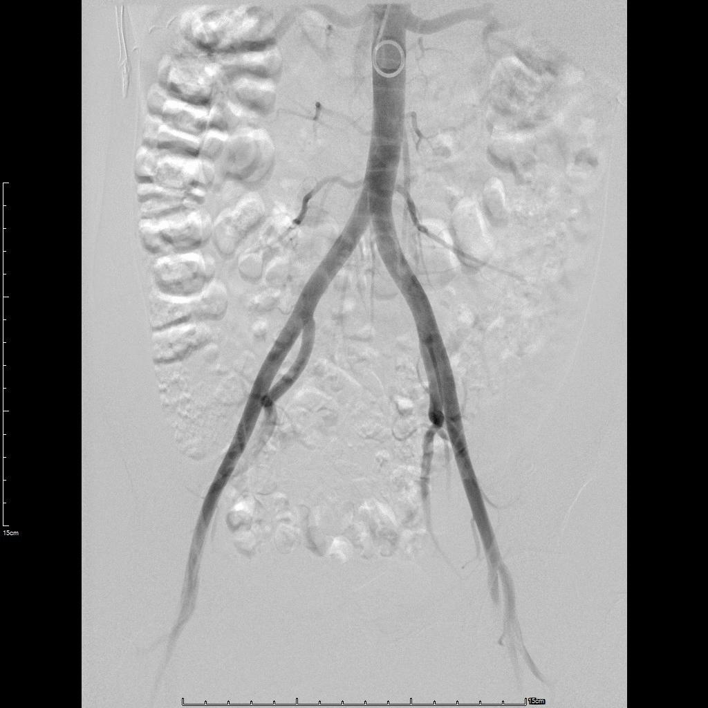 子宫腺肌症介入栓塞全国哪里好,子宫腺肌症介入栓塞治疗报销吗