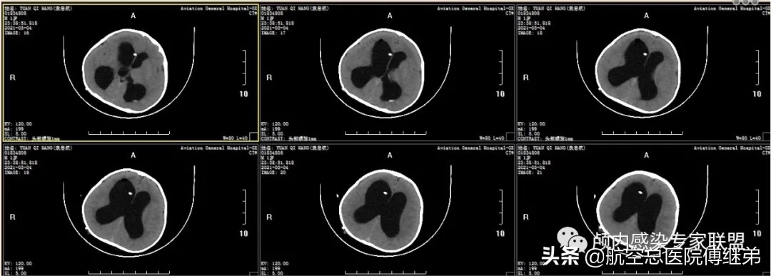婴儿脑积水治疗方法动画演示,ommaya囊植入术是大手术吗