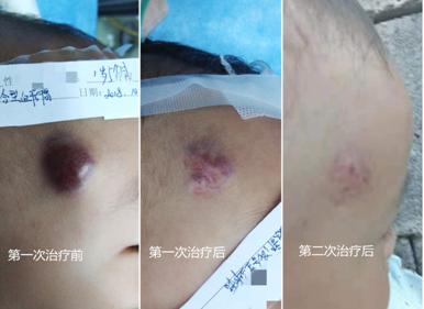 混合型血管瘤的治疗办法,混合型血管瘤的最佳治疗方法