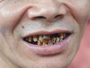 长期吃槟榔的人有哪些表现,长期吃槟榔的人牙齿是怎么样的