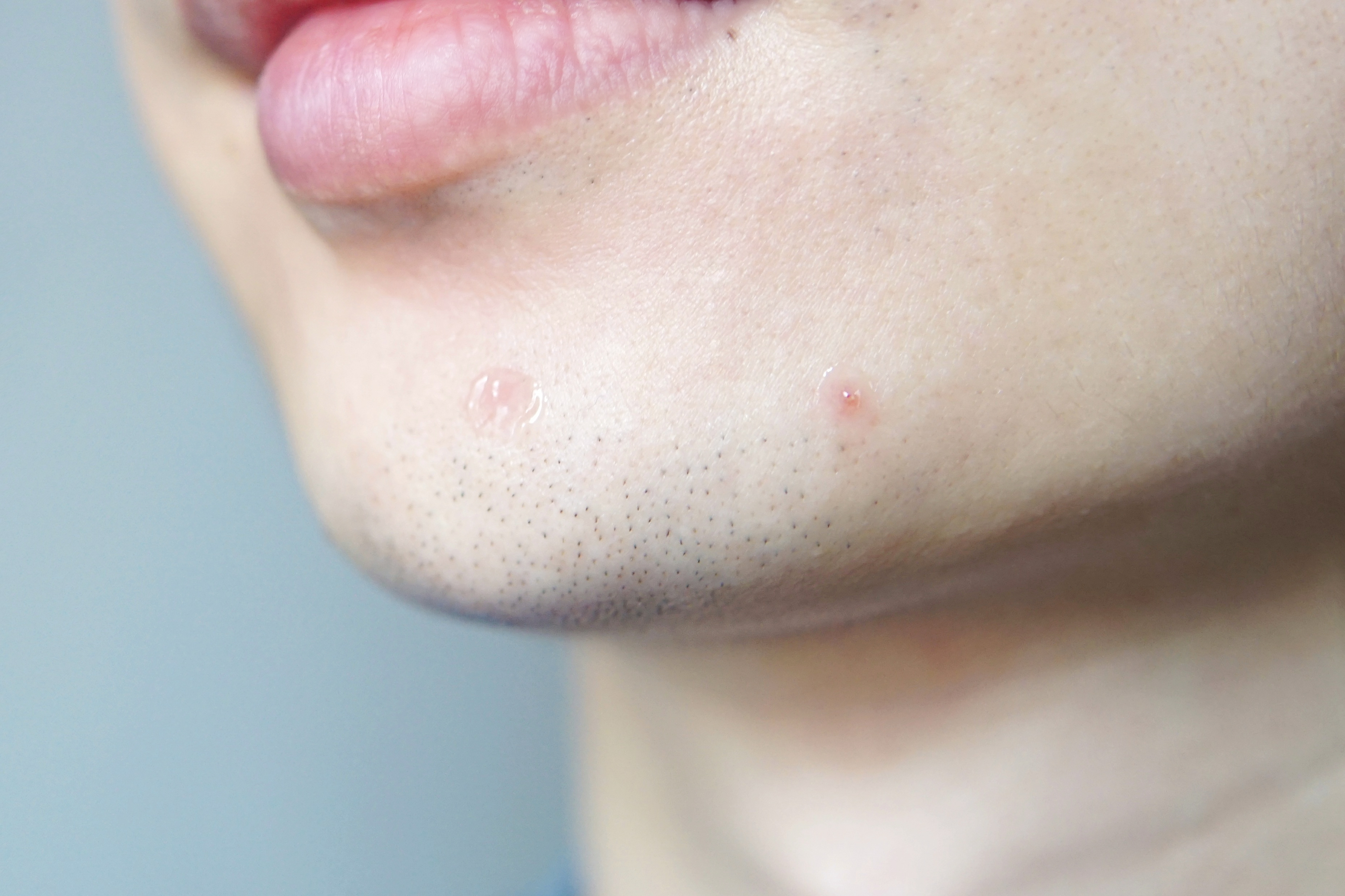 夏日科学战痘攻略,全套战痘攻略