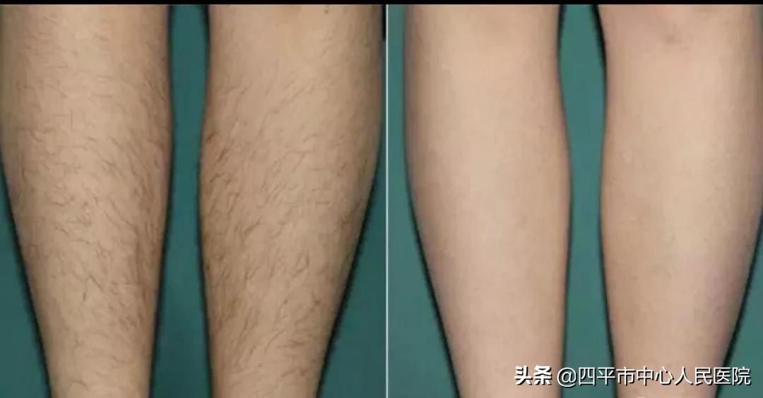 四平中心医院皮肤科谁看得好,激光脱毛四平