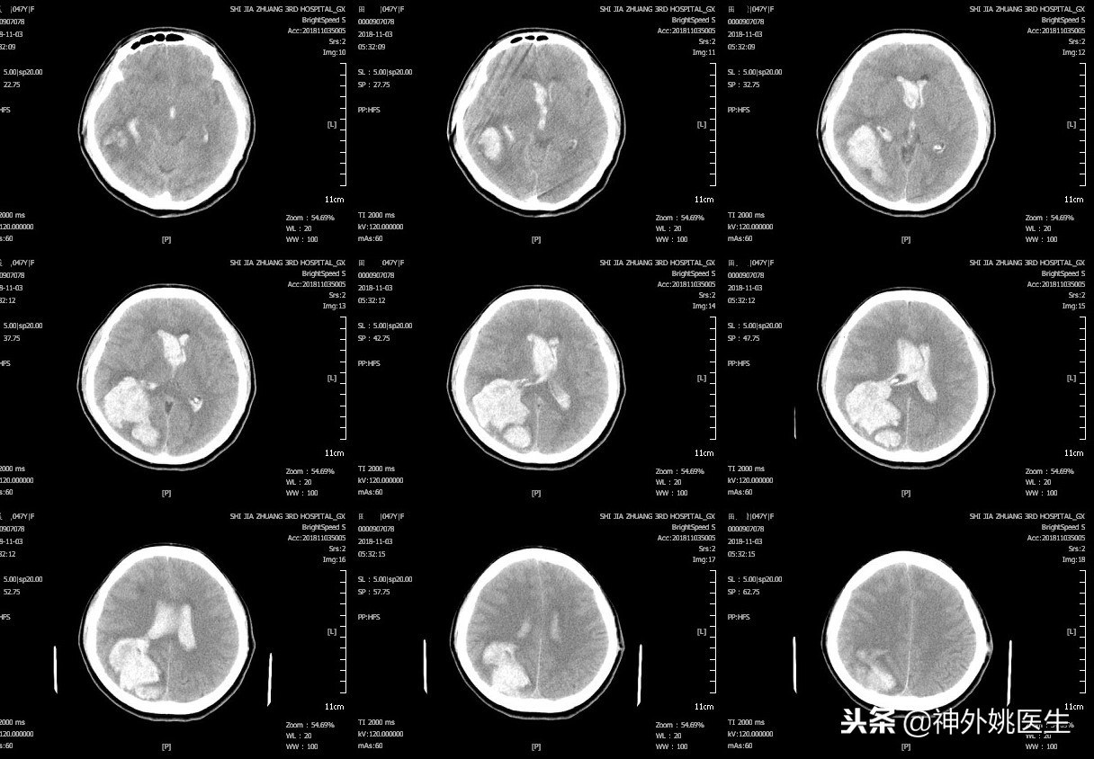 球囊扩张血肿怎么办,神经内镜辅助脑内血肿清除