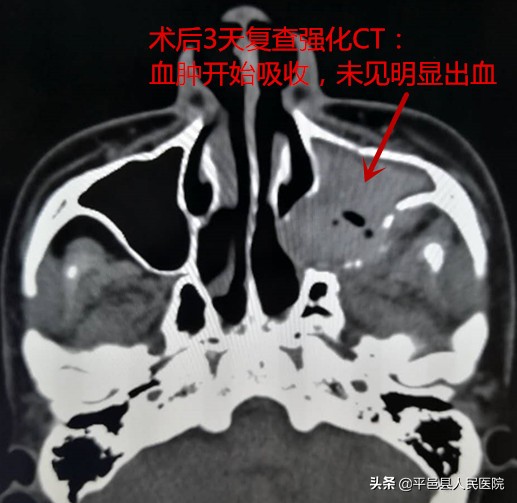 鼻出血止血的方法有血管栓塞法吗,介入治疗鼻出血是怎么操作