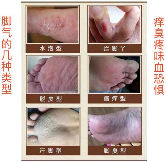 脚臭怎么紧急补救,脚臭如何1秒解决