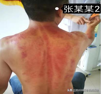 李氏砭法刮痧直播,李氏虎符铜砭刮痧治腰椎间盘突出