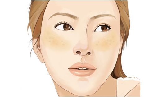 如何区分脸上色斑类型图片,如何辨别面部的各种斑