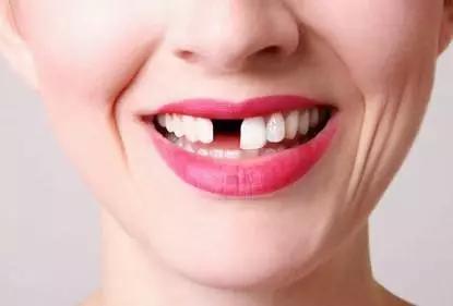 缺了一颗牙不影响吃饭,缺了一颗牙不补