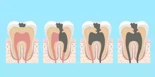 补过牙然后补的地方掉了,补过牙的地方又有蛀牙了